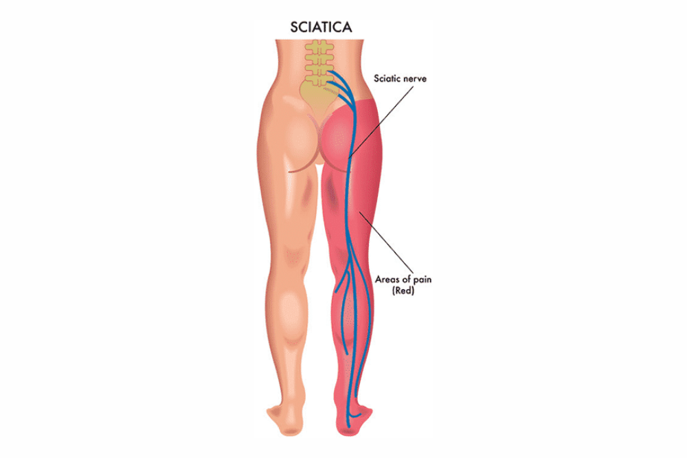 A diagram of the sciatic nerve.